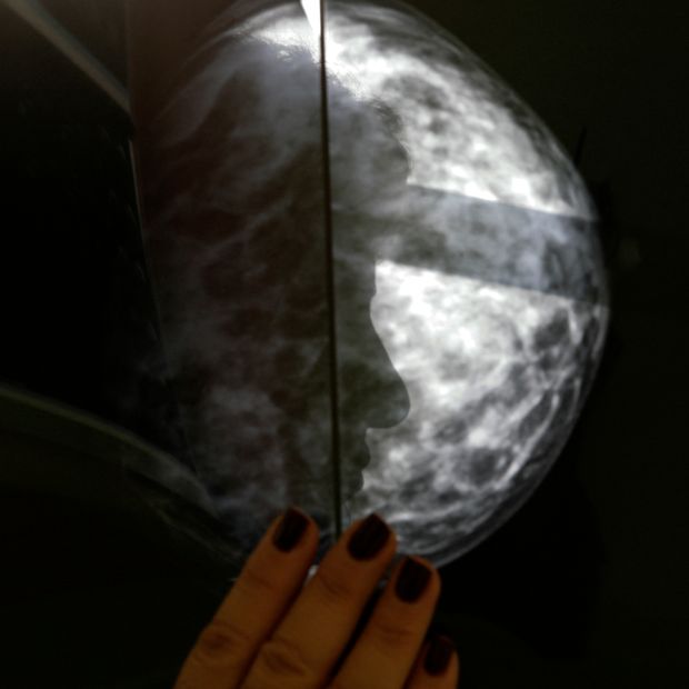 Desarrollan un Modelo de IA para Detectar Metástasis de Cáncer de Mama en la Axila